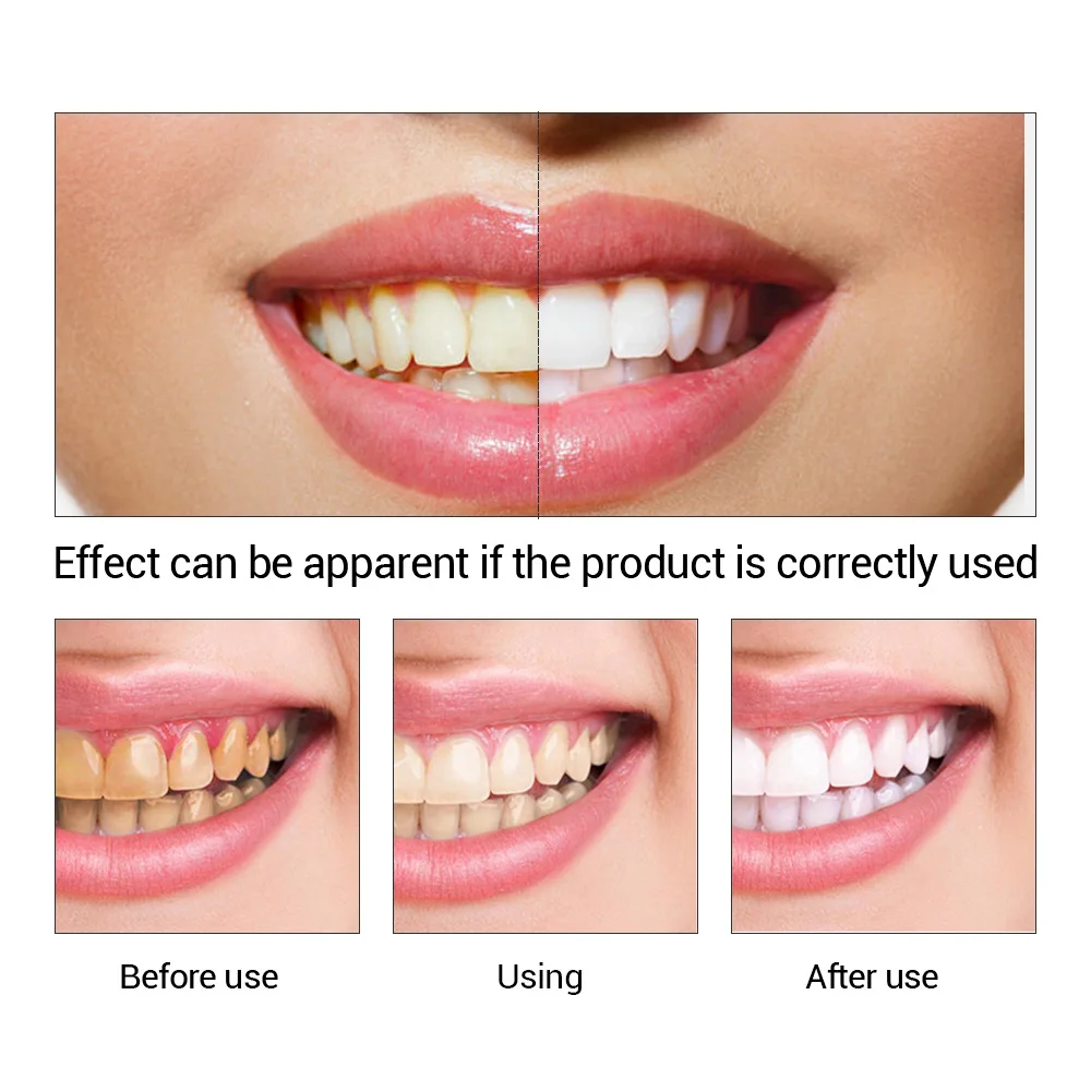 Fteenply Tanden Whitening Esse - Teeth Whitening Lab recensie en prijs