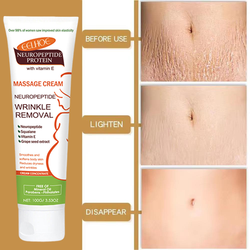 100g Striae Permanente Verwijd - Teeth Whitening Pregnancy recensie en prijs